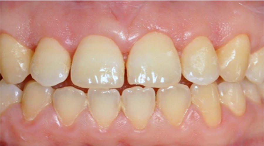 بعد تجميل وعلاج اللثة مركز دكتور ايمن الغمراوى لطب الاسنان 3